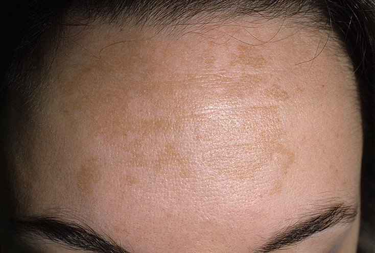 Гиперпигментация кожи: причины, профилактика, подборка средств.